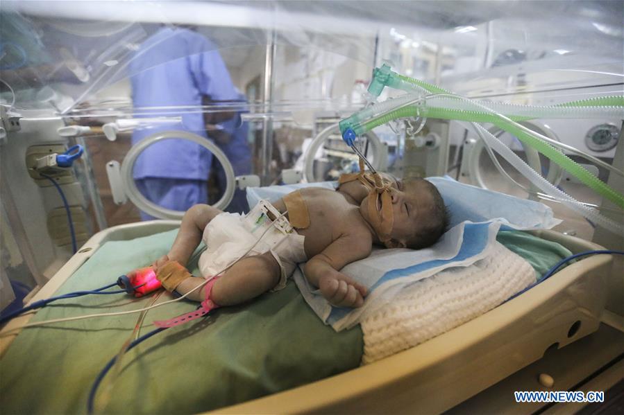 MIDEAST-GAZA-CONJOINED TWINS