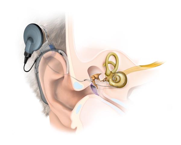 军医科普:电子耳蜗,先天性耳聋患儿的福音