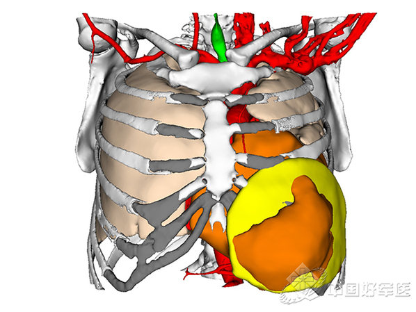 西南医院利用医学3D打印技术为患者重建胸