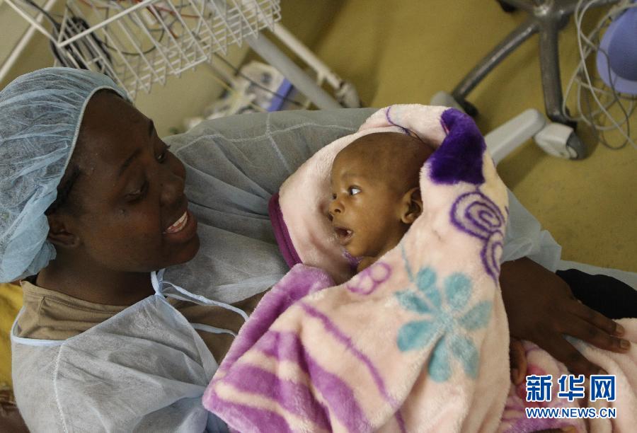 （国际）（1）津巴布韦首次成功分离连体婴儿