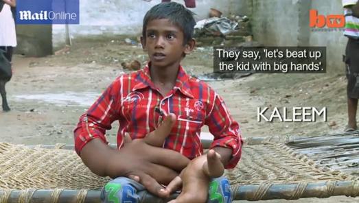 印度8岁男孩患病长出巨人手掌 每只手大如头(图)
