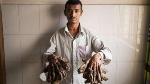 孟加拉“树人”手术成功切除右手“树根”展笑颜