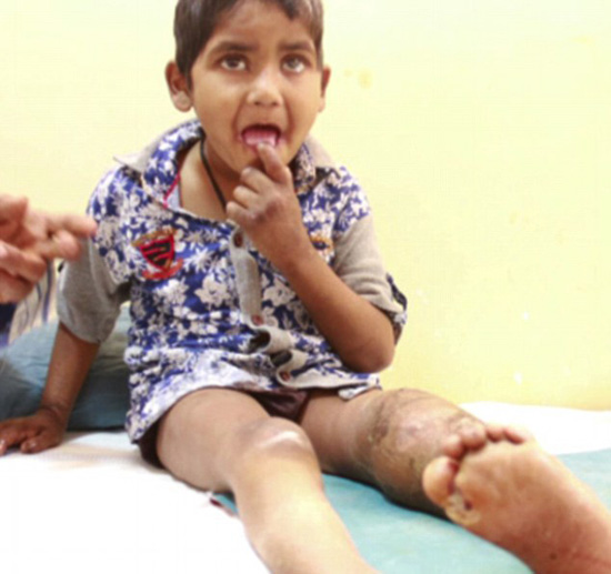 印度姐弟患罕见无痛症 啃掉自己手指不觉疼痛