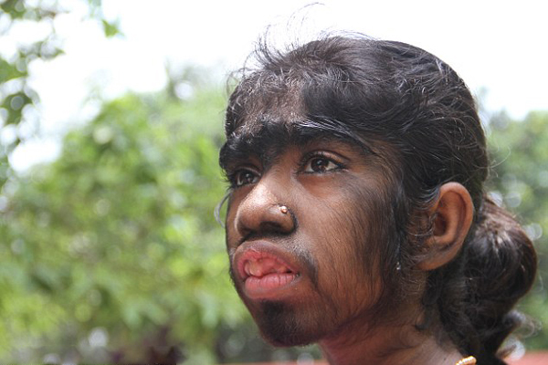 孟加拉国12岁少女因狼人综合症浑身布满毛发