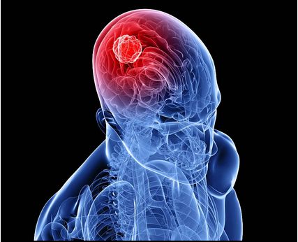 美国医学新发现：脑瘤切多少？激光说了算
