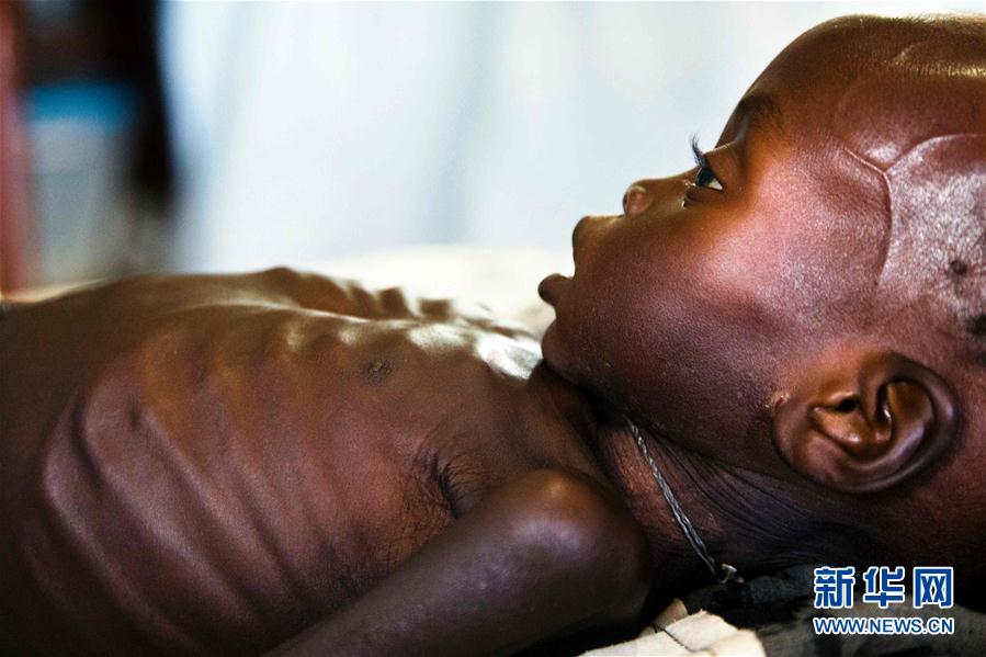 联合国说饥荒导致百余万儿童严重营养不良(组图)