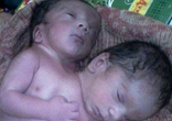 印度女子产下双头男婴 共用心脏等器官