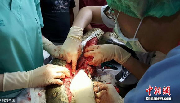 泰国52公斤蟒蛇接受心脏手术 切除1公斤肿瘤